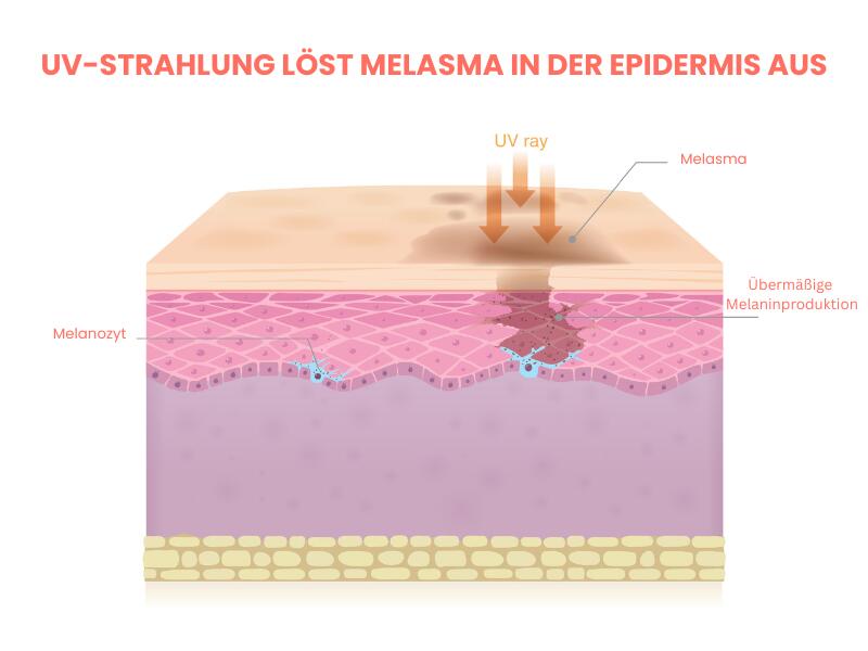 Illustration eines Hautquerschnitts, in dem UV-Strahlen auf die obere Hautschicht treffen und eine Überproduktion von Melanin auslösen, wodurch sich im Bereich der Epidermis eine dunklere Pigmentierung (Melasma) bildet.